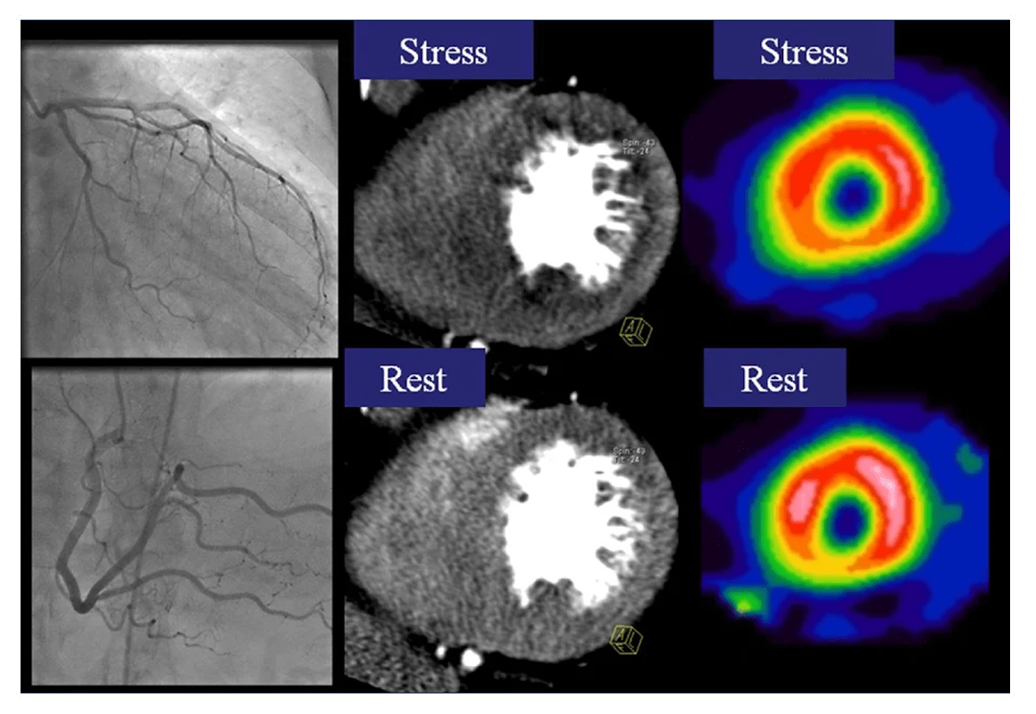 Myocardial perfusion scan